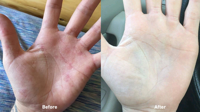 Eczema X before after results extra natural