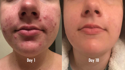 Acne Fade before and after face