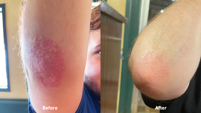 Psoriafacs psoriasis before after results extra natural